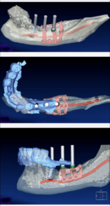 Инновационный имплант - PSI - Patient specific implant